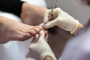 Tratamientos para uñas encarnadas en Castellón